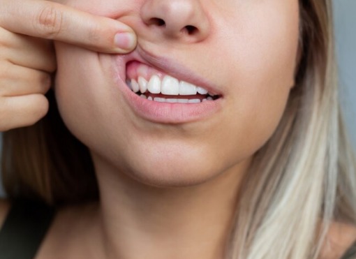 Paciente mulher mostrando a gengiva