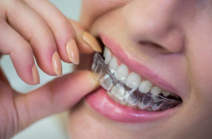 Paciente a fazer uso de alinhadores invisíveis
